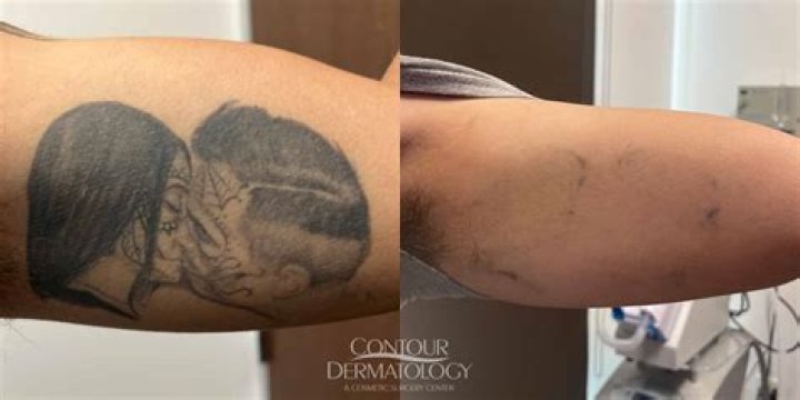 Discover The Truth: Tattoos Before Surgery